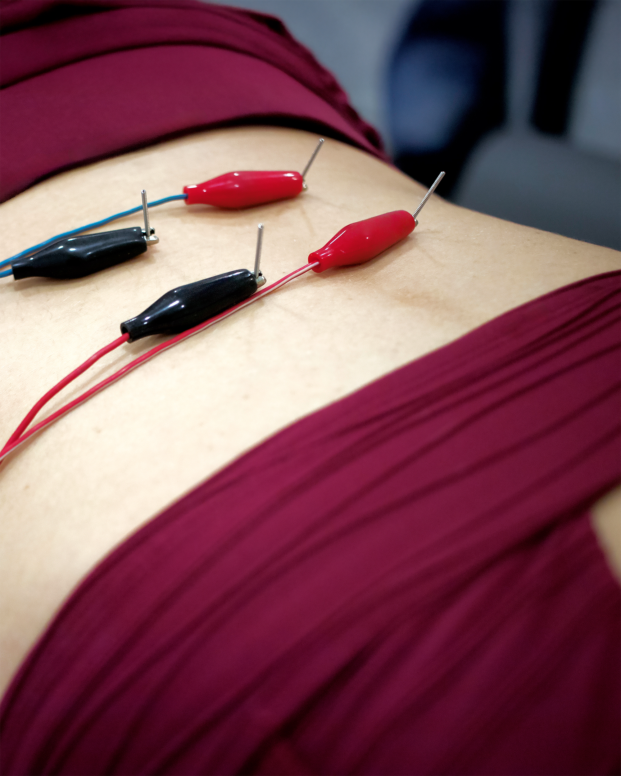 A woman lying on a table with electrodes and needles attatched to her back. 